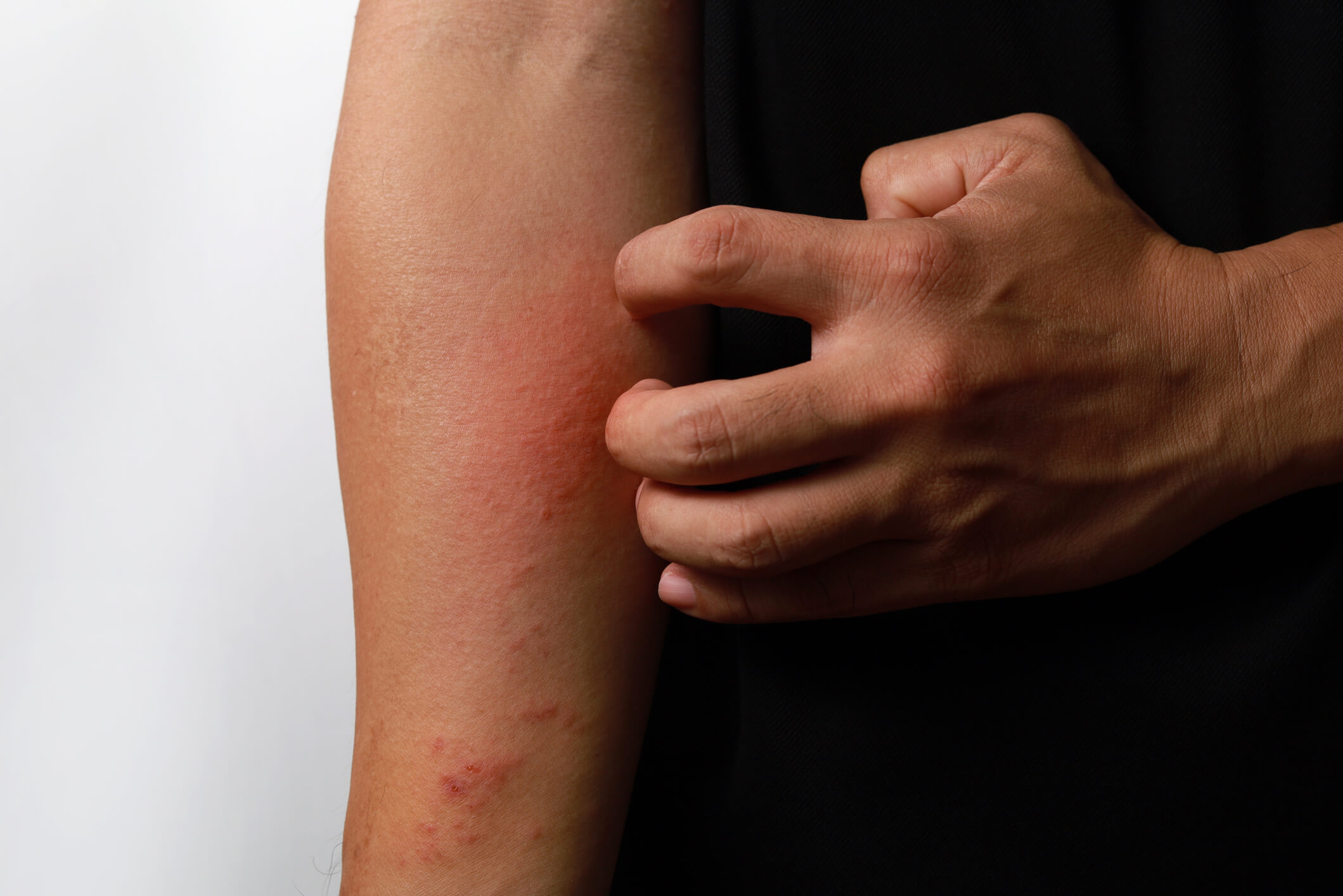 Image of scratching an itchy eczema rash
